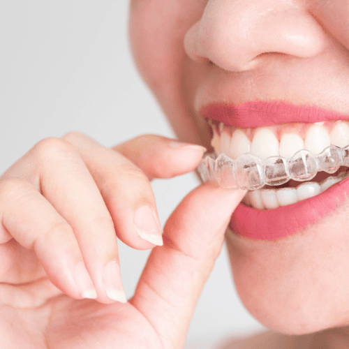 Invisalign