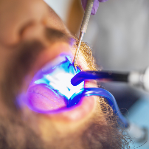 Dental Filling
