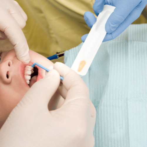 Fluoride Treatment