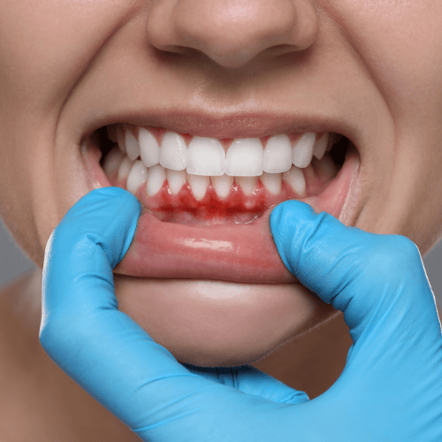 Gum disease