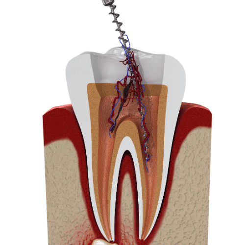 Picture of a root canal
