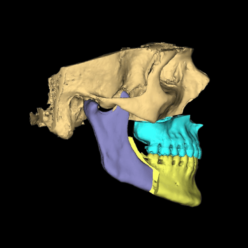 Picture of a surgical plan for orthognathic jaw surgery