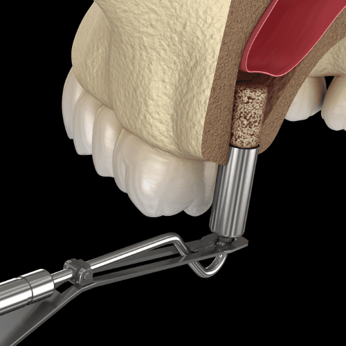 Picture of a Sinus Lift