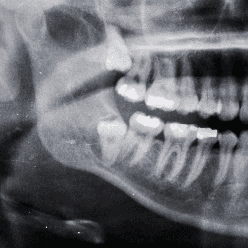 Picture of a wisdom tooth